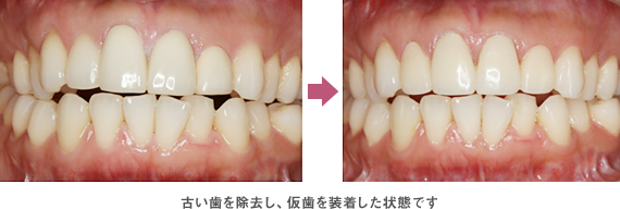 古い歯を除去し、仮歯を装着した状態です